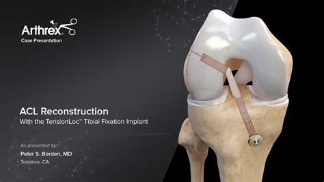 ACL Reconstruction .